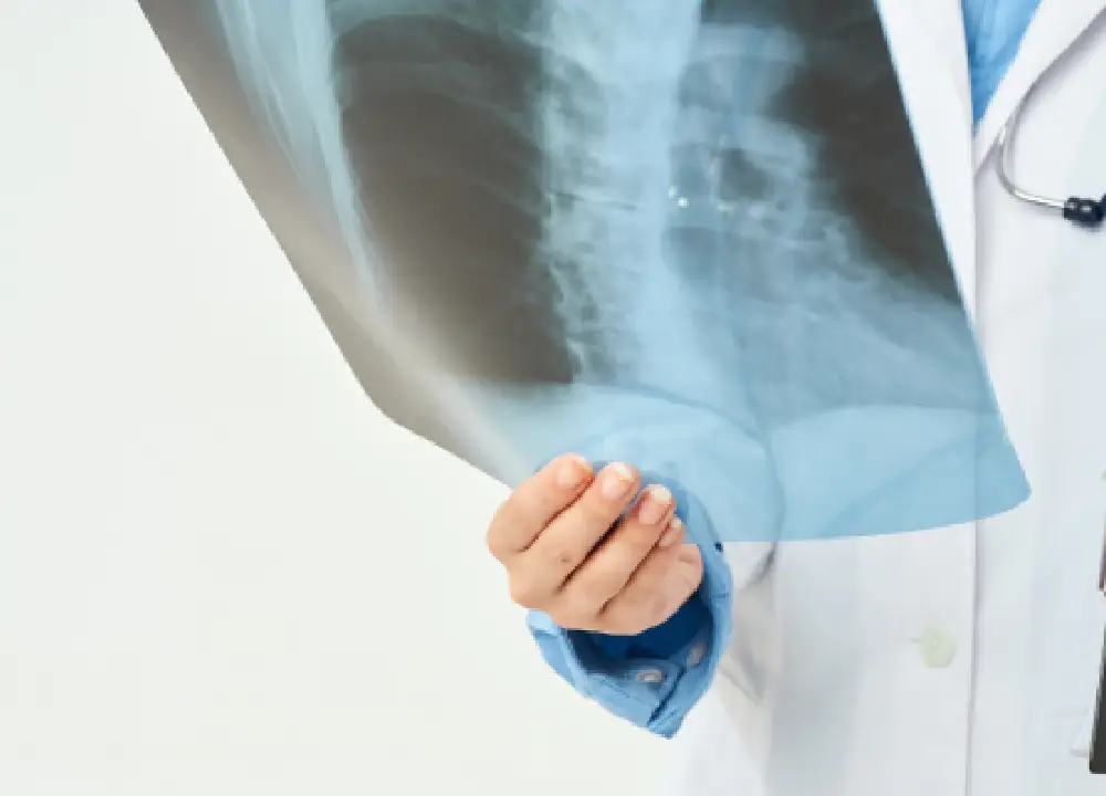 X-ray image of a broken or cracked rib highlighting rib injury.